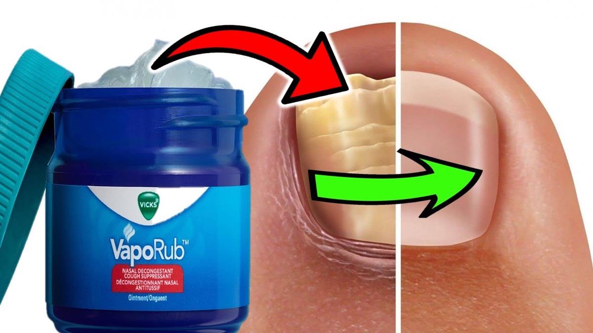 HOW TO USE VICKS VAPORUB TO TREAT TOENAIL FUNGUS