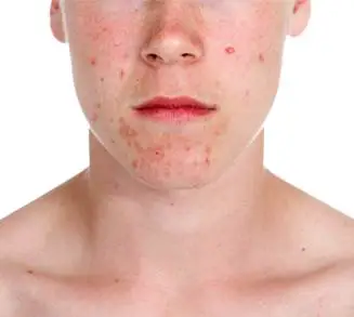 acne aloe evra