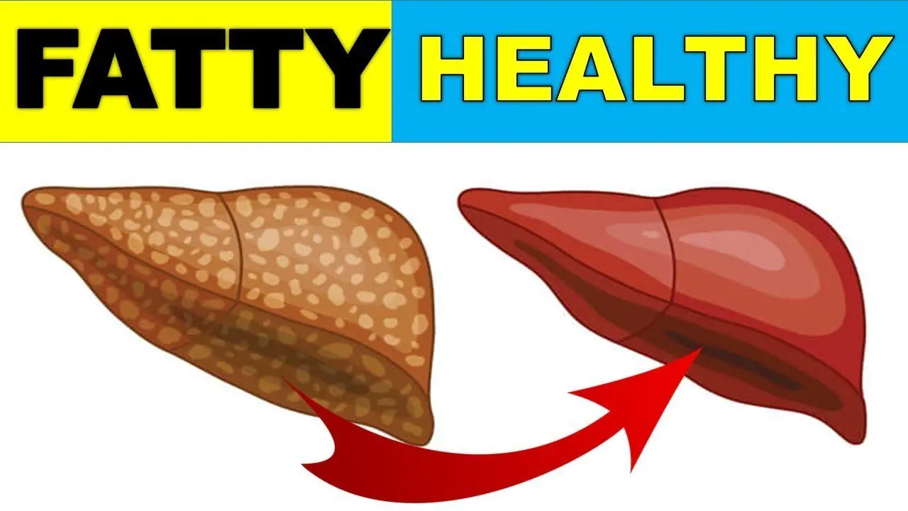 fatty liver