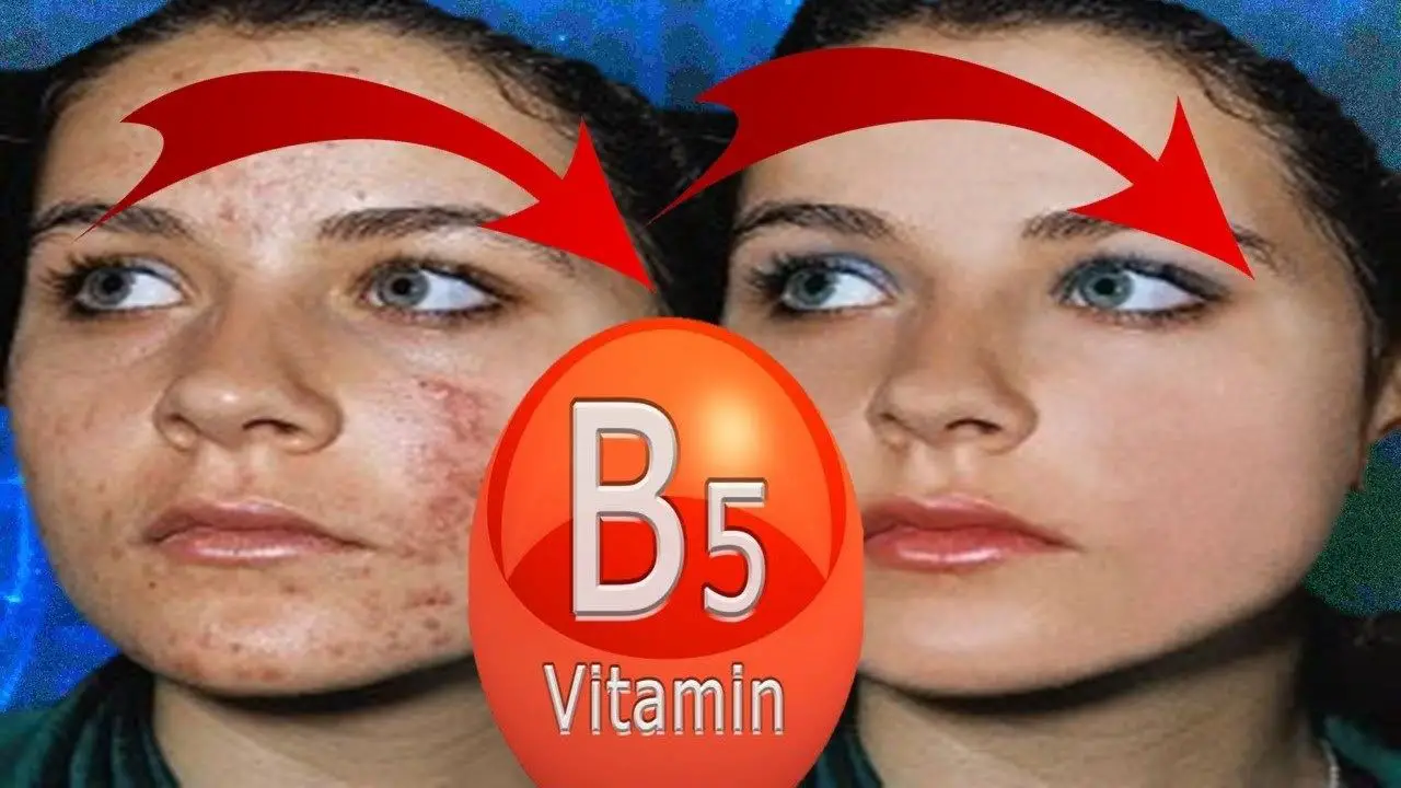 5 Amazing Benefits of Vitamin B5 Pantothenic Acid for Acne, Oily Skin