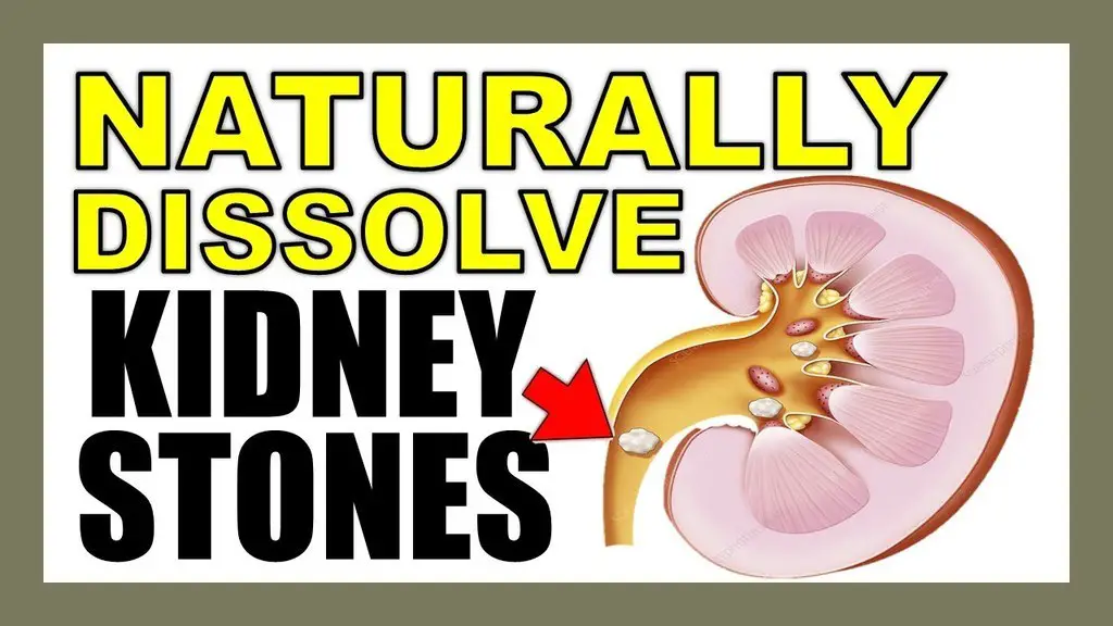 kidney stones image