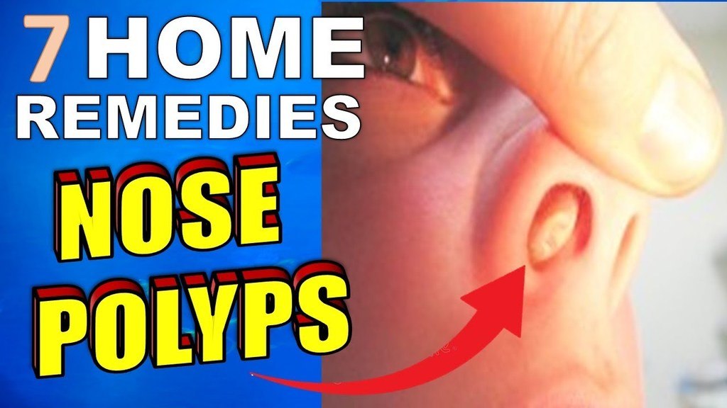 nasal polyps image