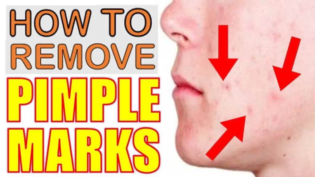 pimple marks blog image