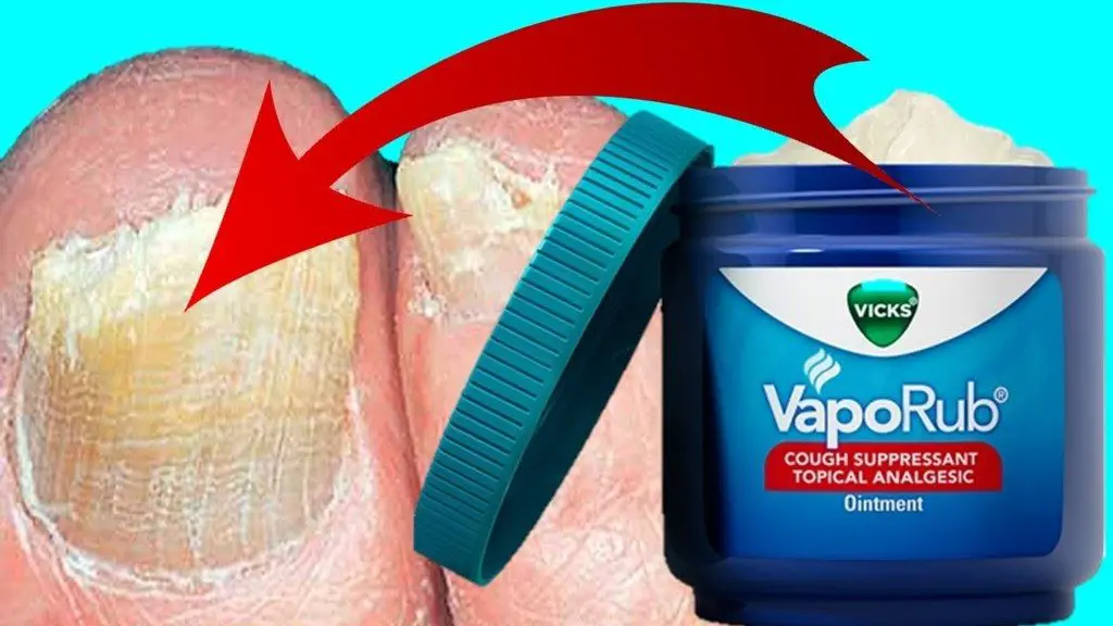 vicks fungal