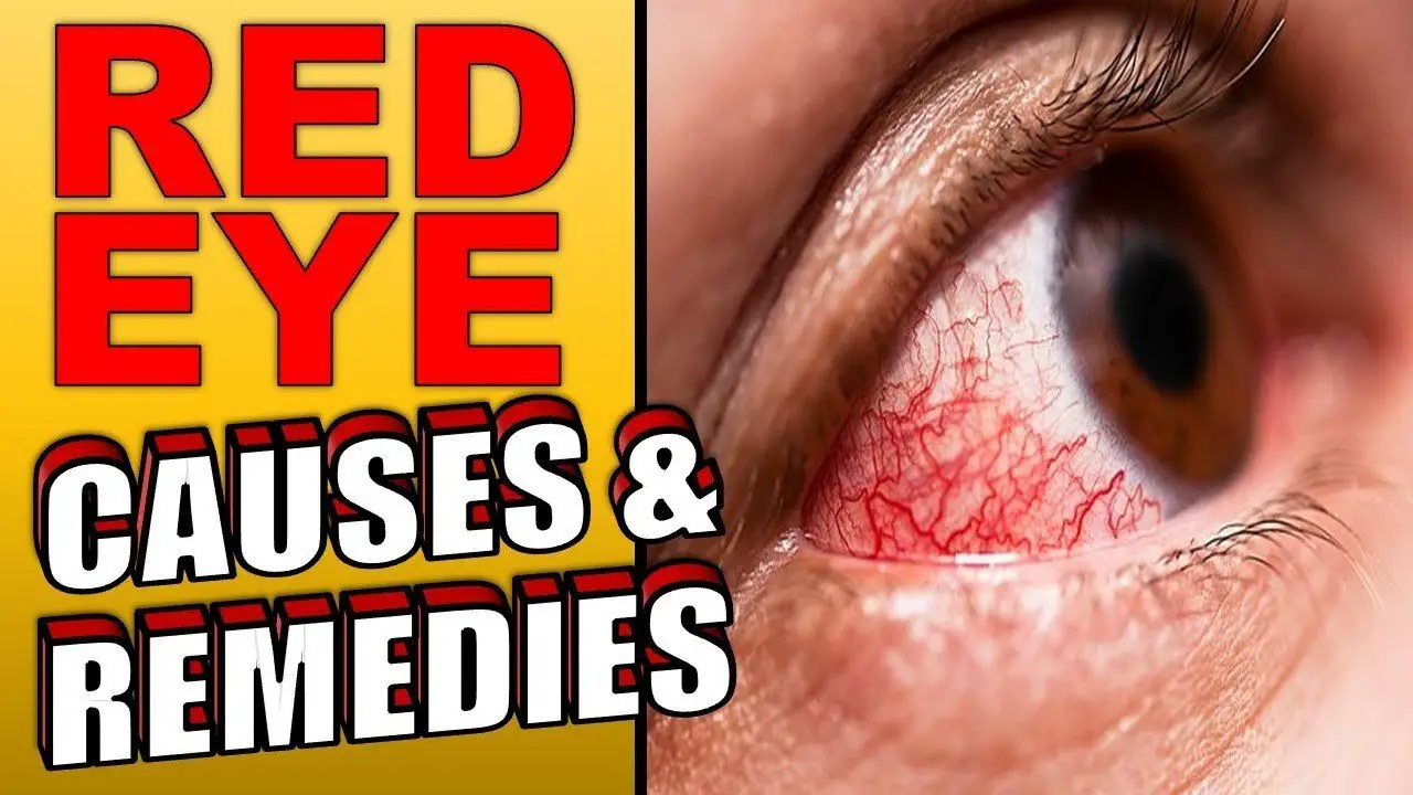 Red Eye causes and remedies