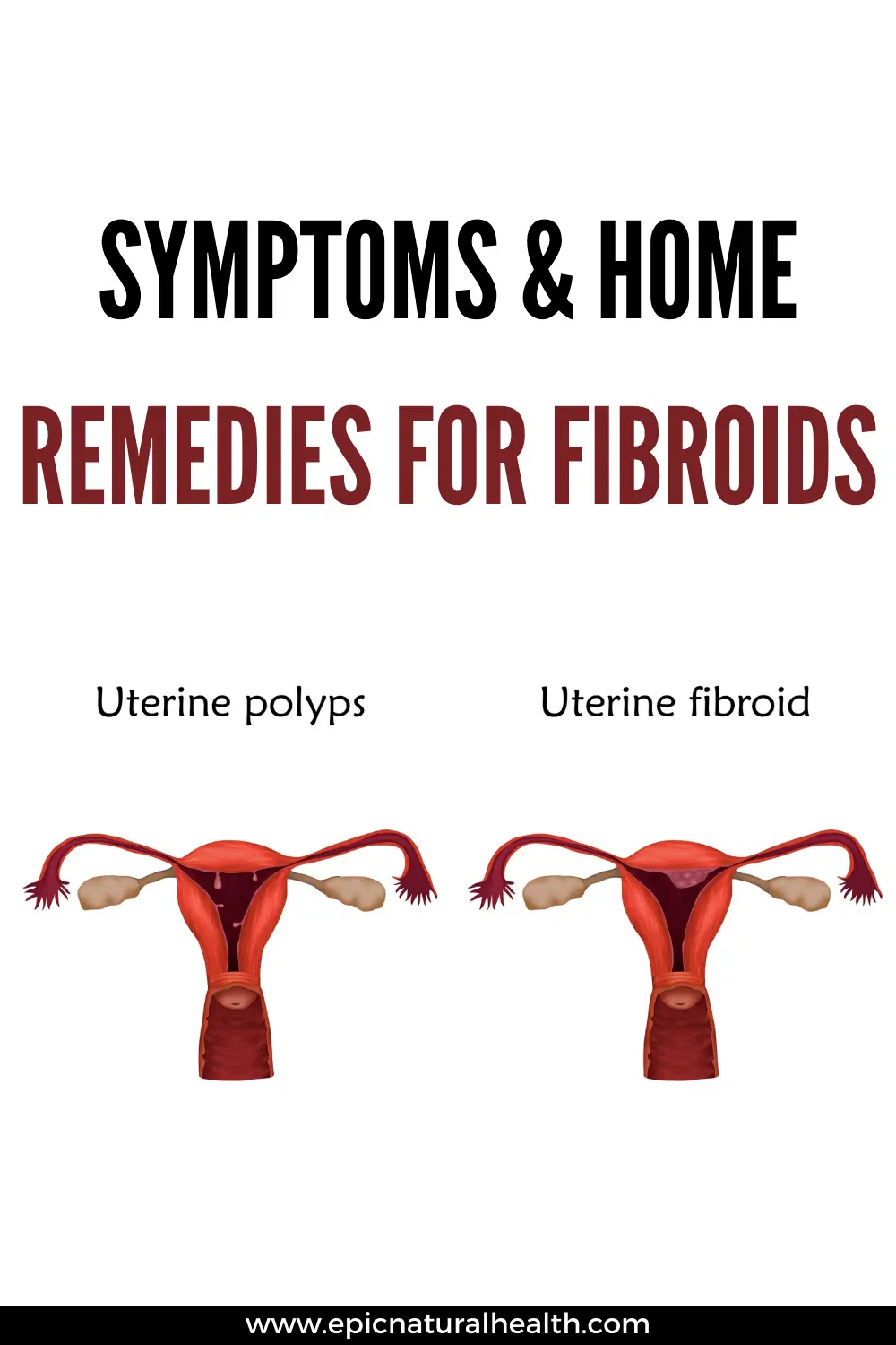 Symptoms and home remedies for fibroids