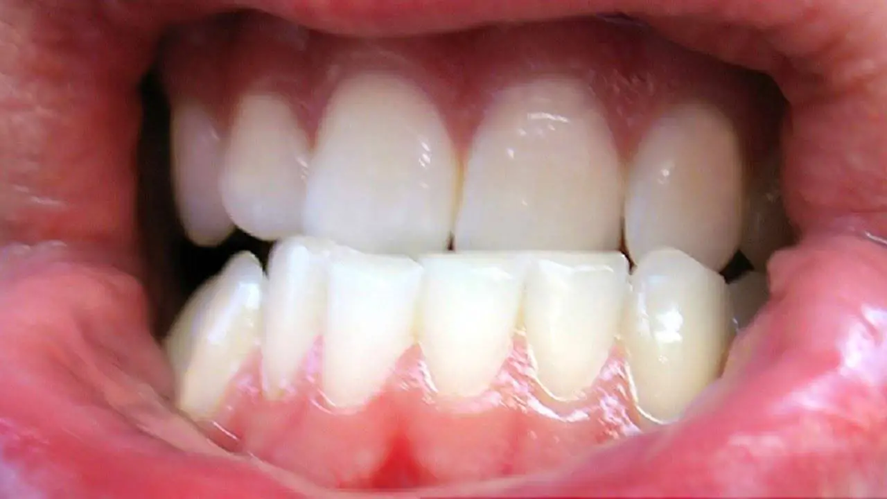 How To Stop Grinding Teeth At Night Naturally Epic Natural Health