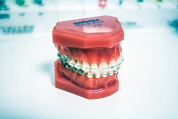 poor dental hygiene especially when wearing braces