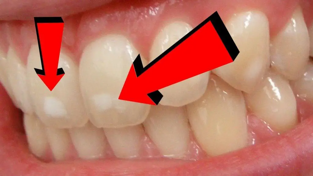 what causes white spots on teeth