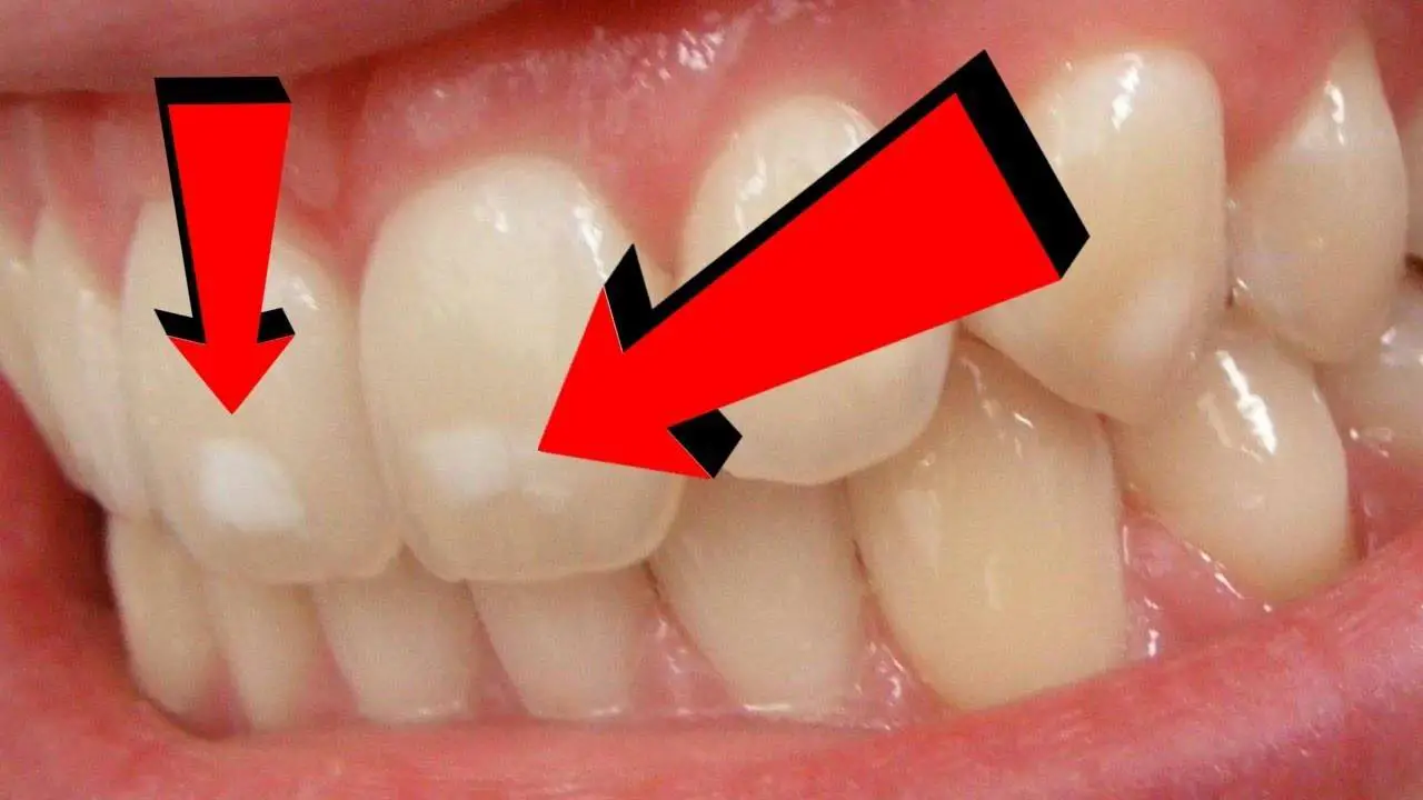 what causes white spots on teeth