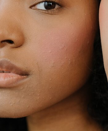 Baking soda as remedy for acne