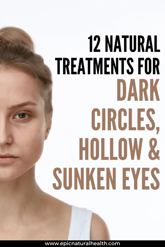 12 Natural Treatments For Dark Circles, Hollow & Sunken Eyes QUICK