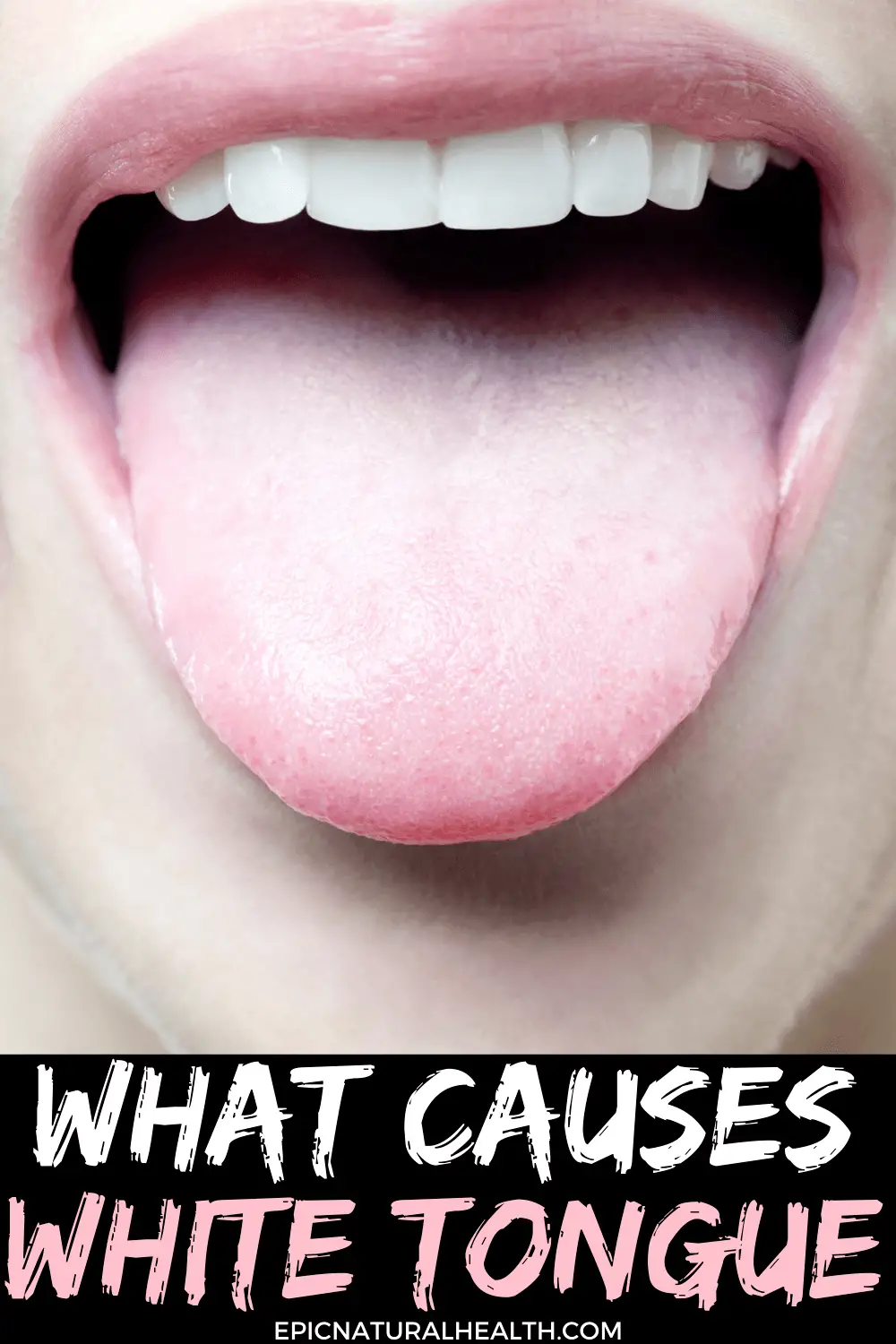 what causes white tongue