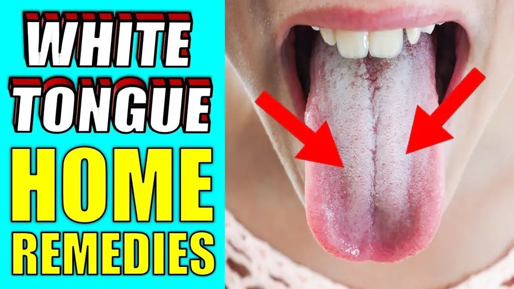 white tongue home remedies