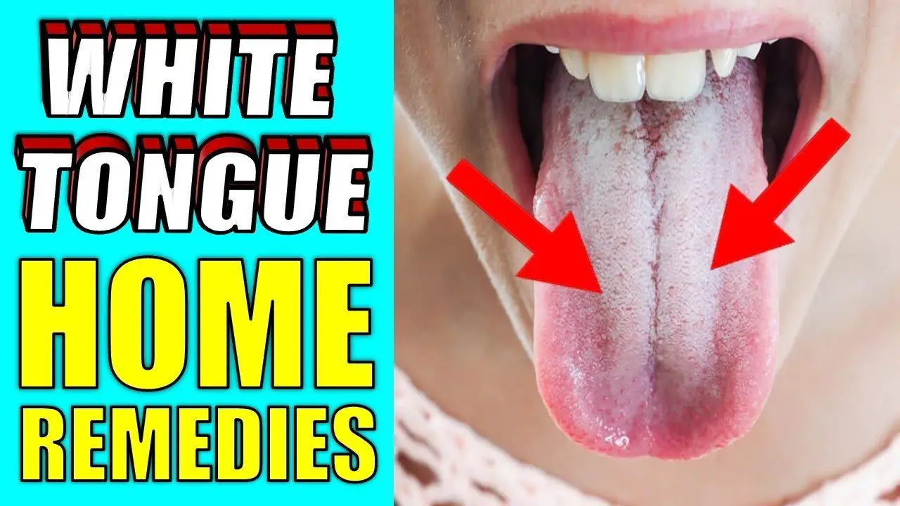 white tongue home remedies