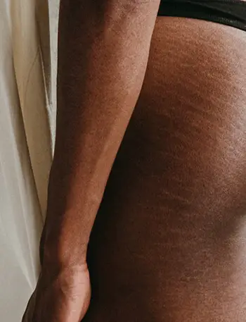 can help minimize stretch marks