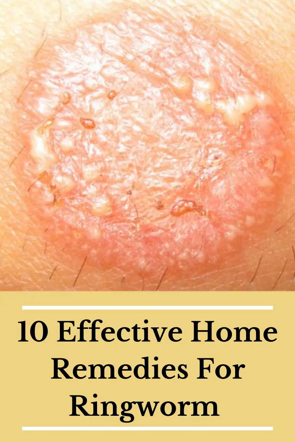 effective home remedies for ringworm