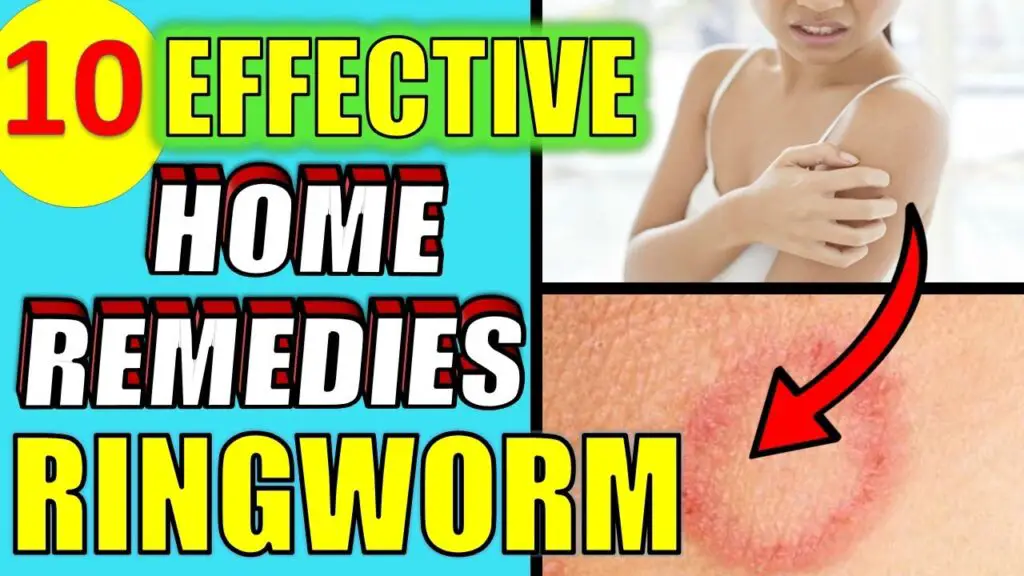 home remedies ringworm