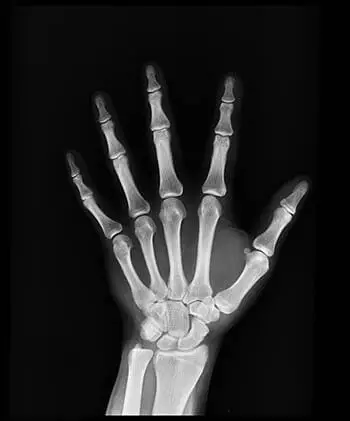 xray of a hand