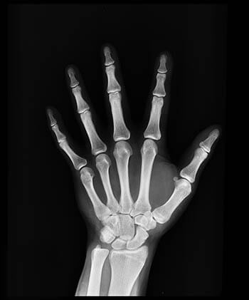 xray of a hand