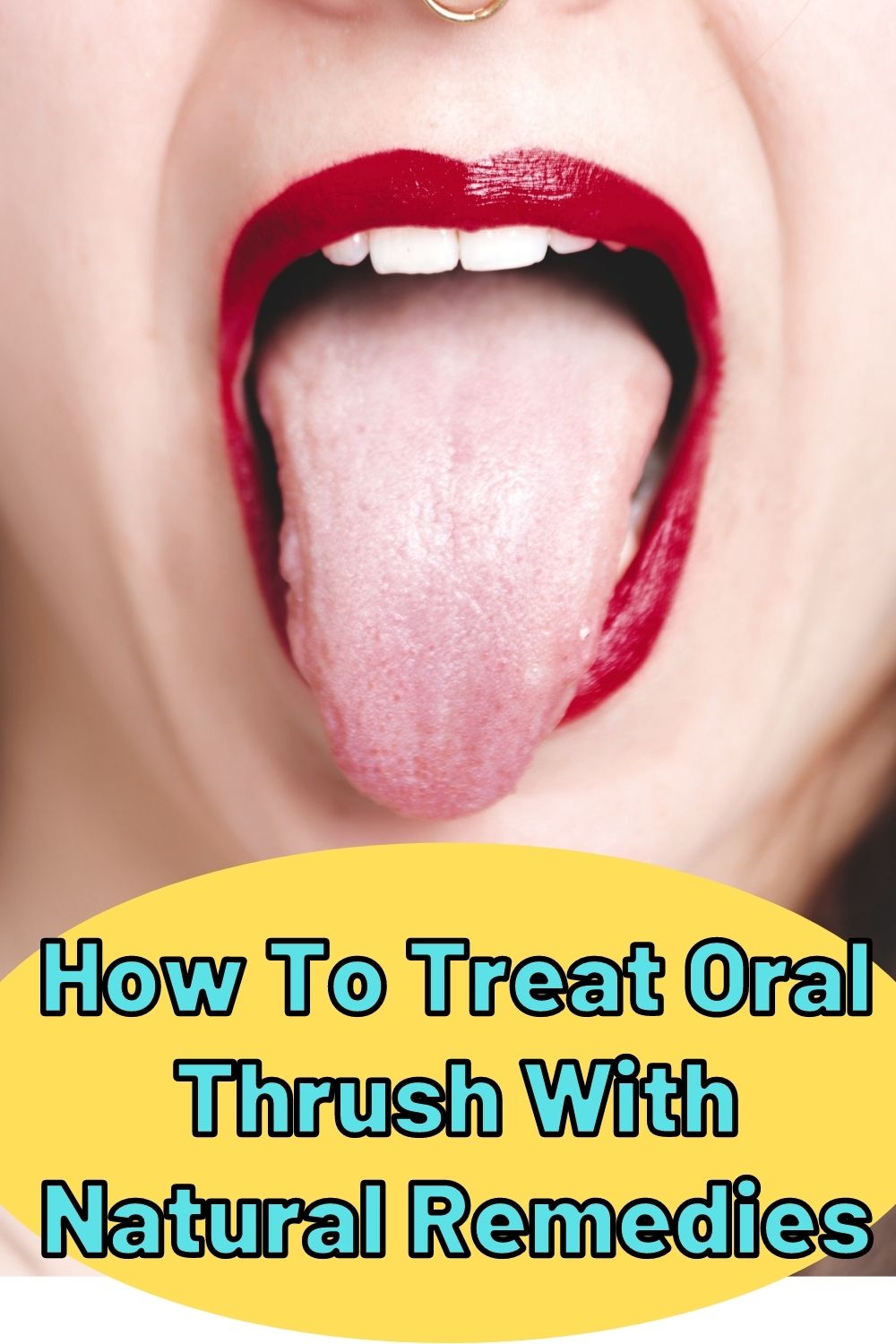 how to treat oral thrush