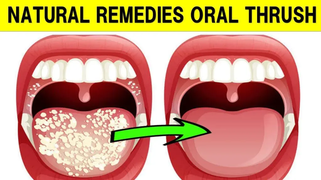 oral thrush natural remedies