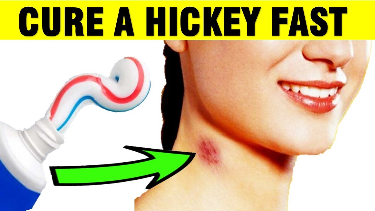 cure a hickey fast