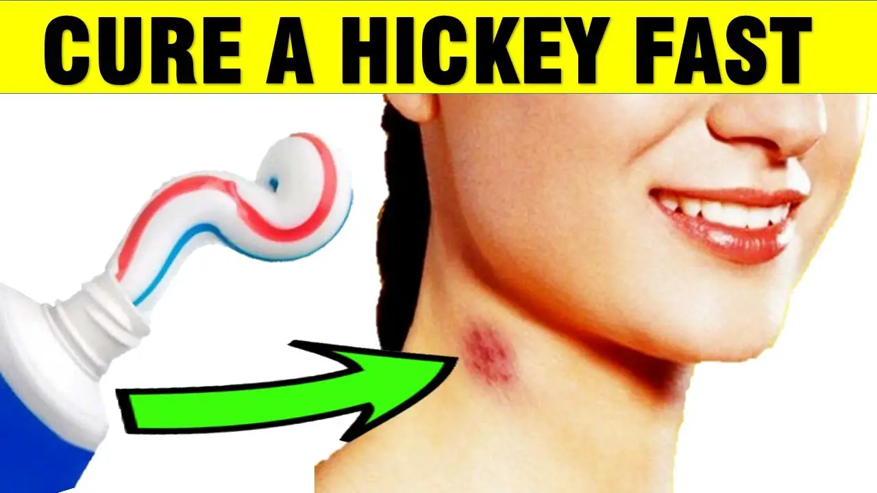 cure a hickey fast