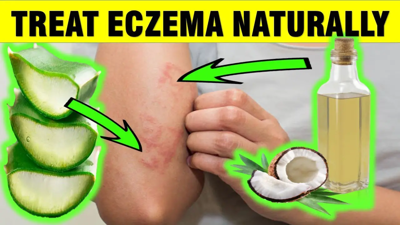 treat eczema naturally