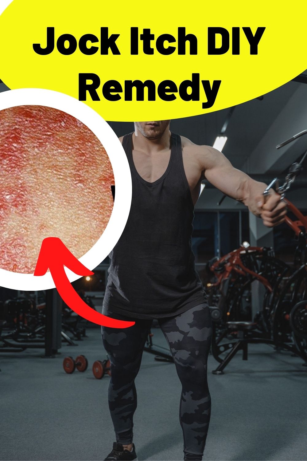 Jock itch diy remedy PIN