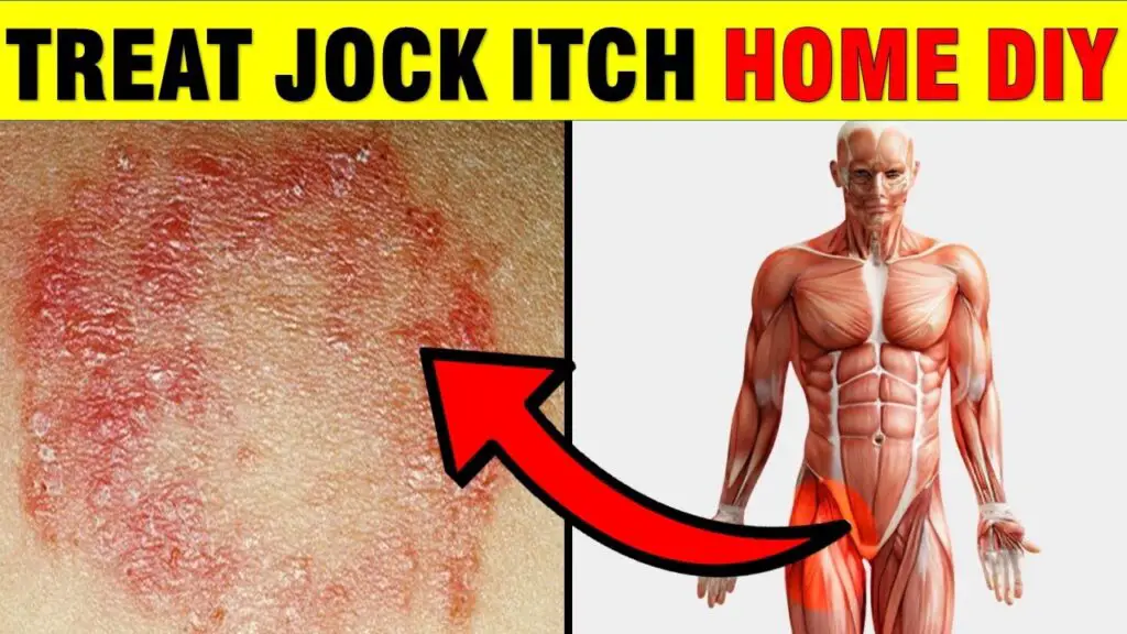 treat jock itch home diy