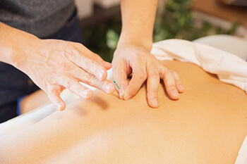 person doing acupuncture