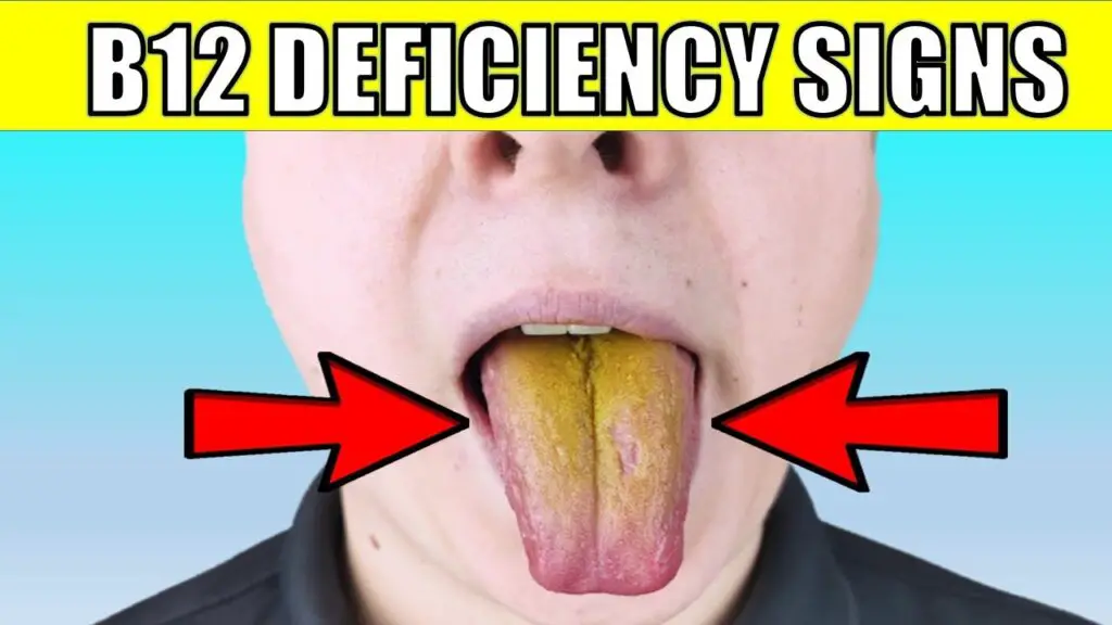 b12 Deficiency signs