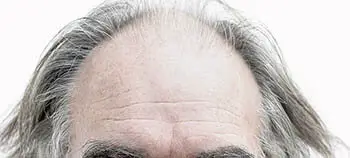 person with wrinkles and thinning hair