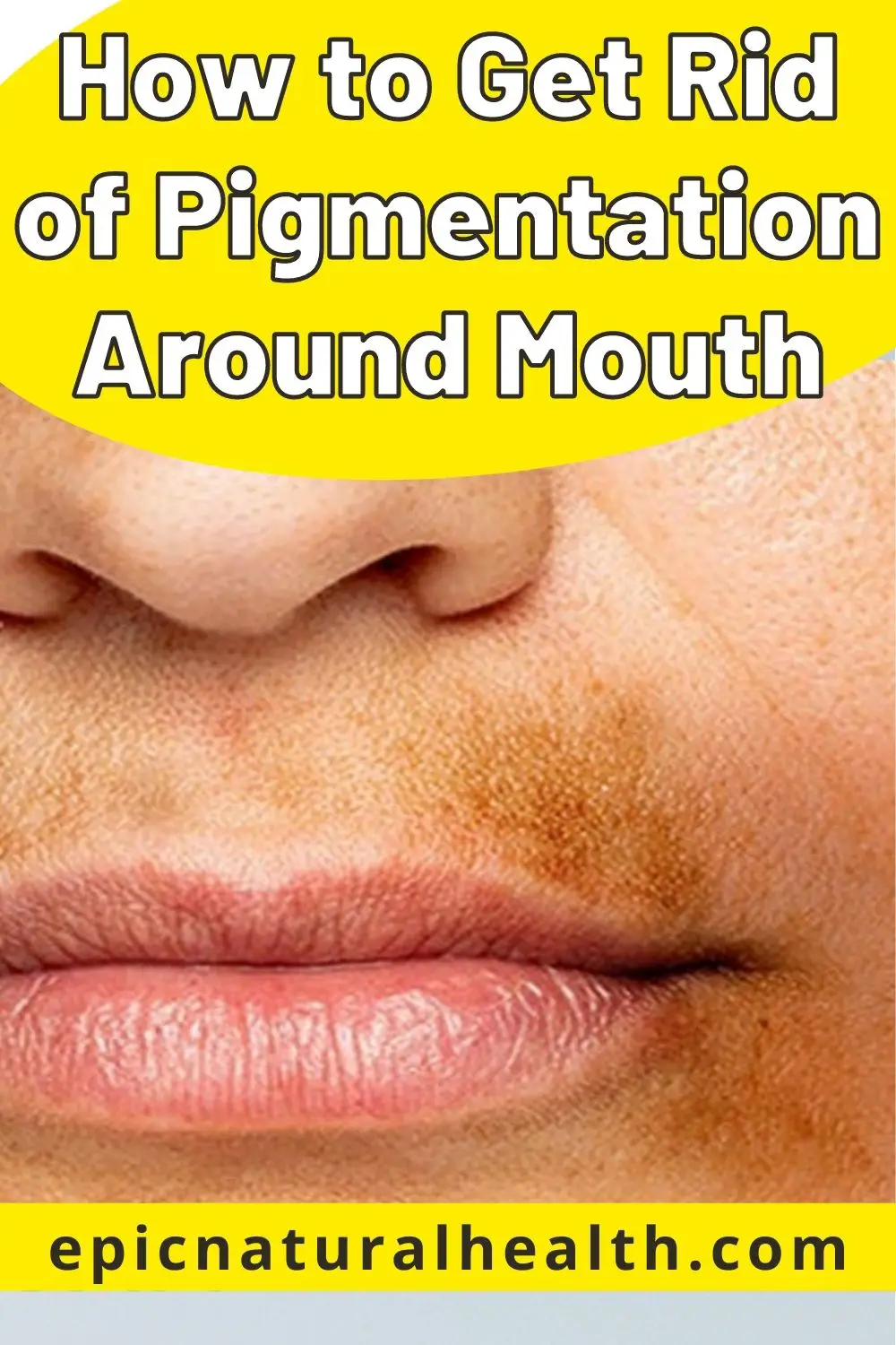 How to Get Rid of Pigmentation Around Mouth