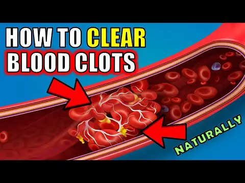 How to Clear blood clots