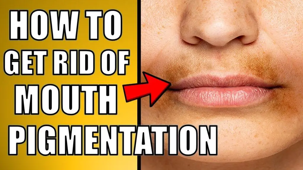 how to get rid of mouth pigmentation